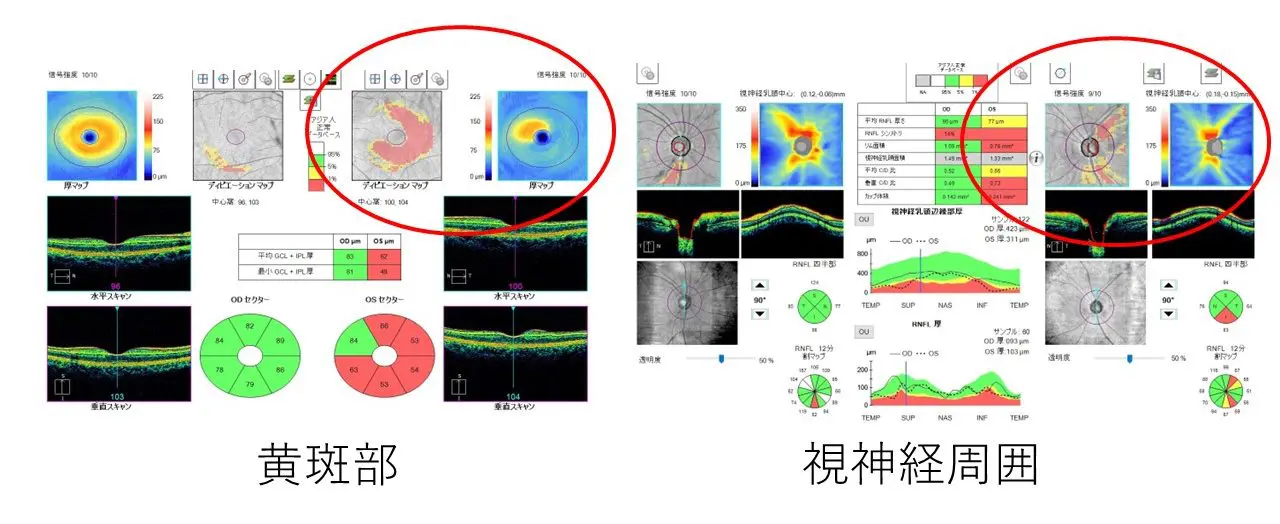 緑内障は早期発見が大切です | おじま眼科クリニック