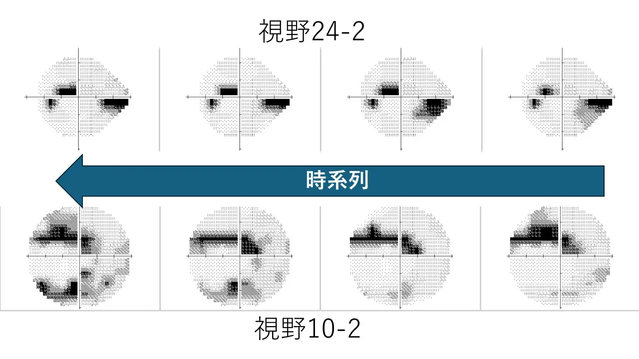 緑内障は早期発見が大切です | おじま眼科クリニック